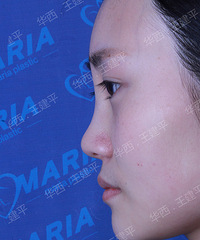 成都隆鼻哪里好?华西鼻综合手术成就我的侧颜杀