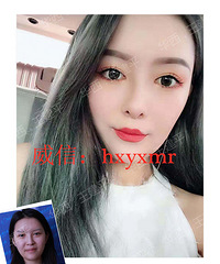 成都鼻综合,全肋骨鼻综合和半肋骨鼻综合又是什么