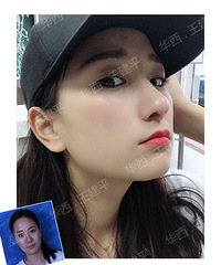 成都鼻综合,全肋骨鼻综合和半肋骨鼻综合又是什么