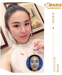 成都埋线提升,做了面部埋线提升术后如何护理?