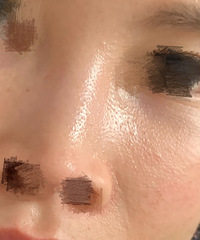 鼻翼两边长的什么?看看你有没有啊