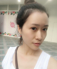 做了双眼皮和脂肪填充后,脸部变得饱满显年轻