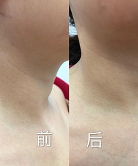 这个比颈膜、按摩棒效果更好,一次颈纹就明显淡化