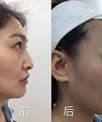 30岁抗衰很重要!体验这个之后,下颌线明显提升