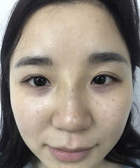 第二次超皮秒祛斑,脸变得白净了,也没有结痂