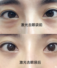 15分钟做了个激光去眼袋 顺带打了除皱针 整个人精神多了!