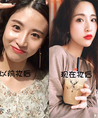 15分钟做了个激光去眼袋 顺带打了除皱针 整个人精神多了!