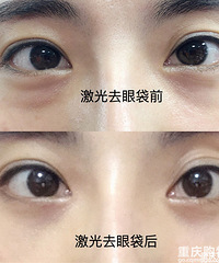 华美6月超值团购!去黑小棕瓶3180、祛眼袋2999、综合隆鼻6800