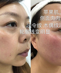 体验面部小熨斗后,法令纹淡化了,轮廓明显提升