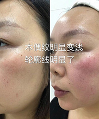 体验面部小熨斗后,法令纹淡化了,轮廓明显提升