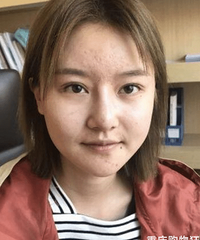 面部吸脂后,圆脸变鹅蛋脸,五官小巧后拍照更好看