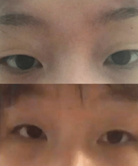 小眼睛变双眼皮大眼后,自然有神,人也变得更自信