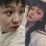 隆鼻后,我像变了张脸