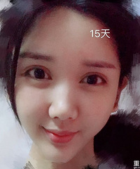 喜欢脸上肉肉的,面部填充后,看起来可爱又年轻