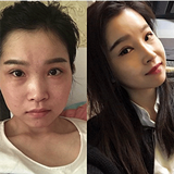 隆鼻后侧面弧线更完美