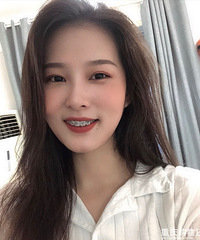 歪七八扭的牙齿矫正后,脸变小了,拍照也敢露齿笑
