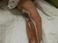 痛心!3岁娃娃手臂被绞伤