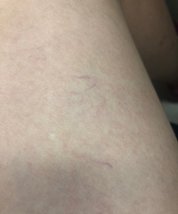 怀孕7个月突然发现腿上长了好多这样的东西,长妊娠纹前兆吗?