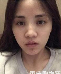 大鼻头变小翘鼻后,鼻型好看,整张脸变得精致小巧