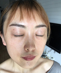 30+老阿姨医美初体验之超皮秒祛斑,来看看我祛斑历程