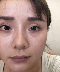 花钱做的双眼皮显老还假,双眼皮修复后变自然多了