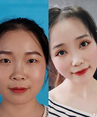 肿眼泡变大双眼皮后,感觉像变了一个人
