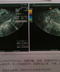 生了孩子后月经变得不正常,产后近3年查出息肉,医生建议手术