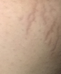 躲不掉的妊娠纹,还是来了