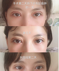 我的双眼皮变化史!双眼皮手术后,感觉越来越自信