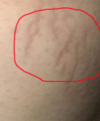躲不掉的妊娠纹,还是来了