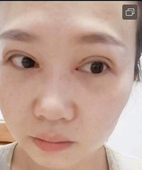 纠结了十年,终于看在便宜的份上去把双眼皮做了~