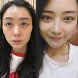 改善上眼皮松弛的方法