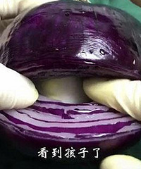 洋葱模拟剖腹产全过程