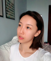 太瘦导致额头干扁,鼓起勇气去做了面填后变得饱满