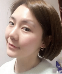 填充泪沟后,不仅淡化了黑眼圈,还能去眼袋