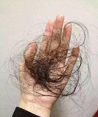 脱发脱到秃头,这样坚持一个月,头发明显掉得少了