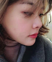 填充下巴后,怎么拍照都好看