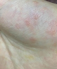 ����ʪ�����أ�������Ϊʹ�ü���ҩ�࣬��ë���д��˵ĳ���
