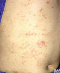 孩子湿疹严重,腿上因为使用激素药膏,腿毛都有大人的长了