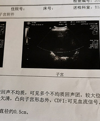 子宫肌瘤差点毁了我的子宫