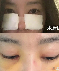 泪沟凹陷看着显老!祛眼袋后,素颜看着也有精气神
