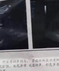 12岁智障女被多人性侵,两次流产