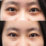 我的黑眼圈终于有救了