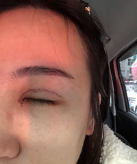 双眼皮第二天,看着还是很宽,你们是这样吗?