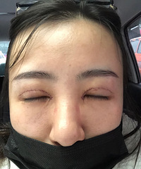 双眼皮第二天,看着还是很宽,你们是这样吗?