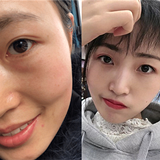 祛眼袋后比以前更自信