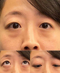 终于鼓起勇气去把遗传性眼袋去掉了,来说说感受