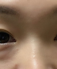 千万不要去切眼袋