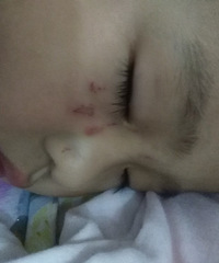 娃儿在幼儿园被抓破相,真的是看着都心痛,希望不要留疤