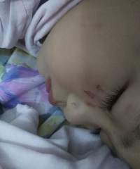 娃儿在幼儿园被抓破相,真的是看着都心痛,希望不要留疤